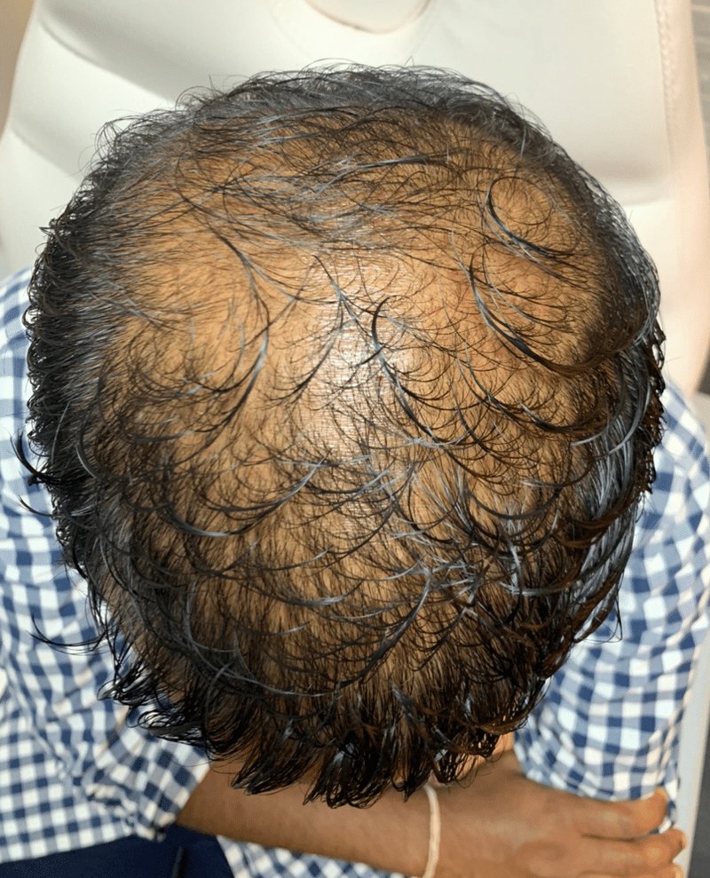 Hairstim opinie - Jak działa Hairstim? Wszystko, co musisz wiedzieć